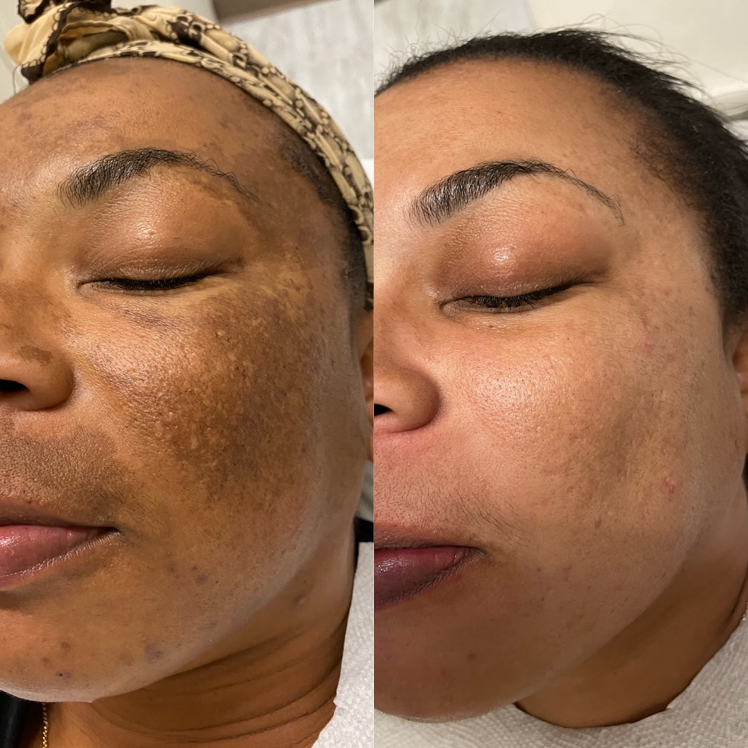 Melasma treatment before and after - visible spot fading