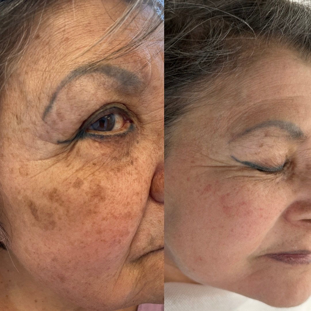 Professional dark spot treatment showing clear improvement