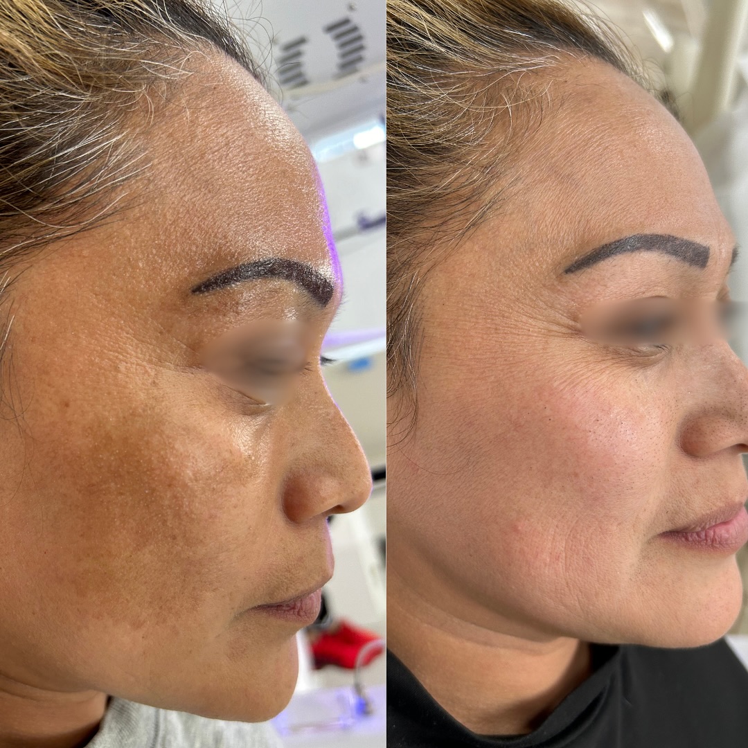 Hyperpigmentation treatment results showing brightened skin tone